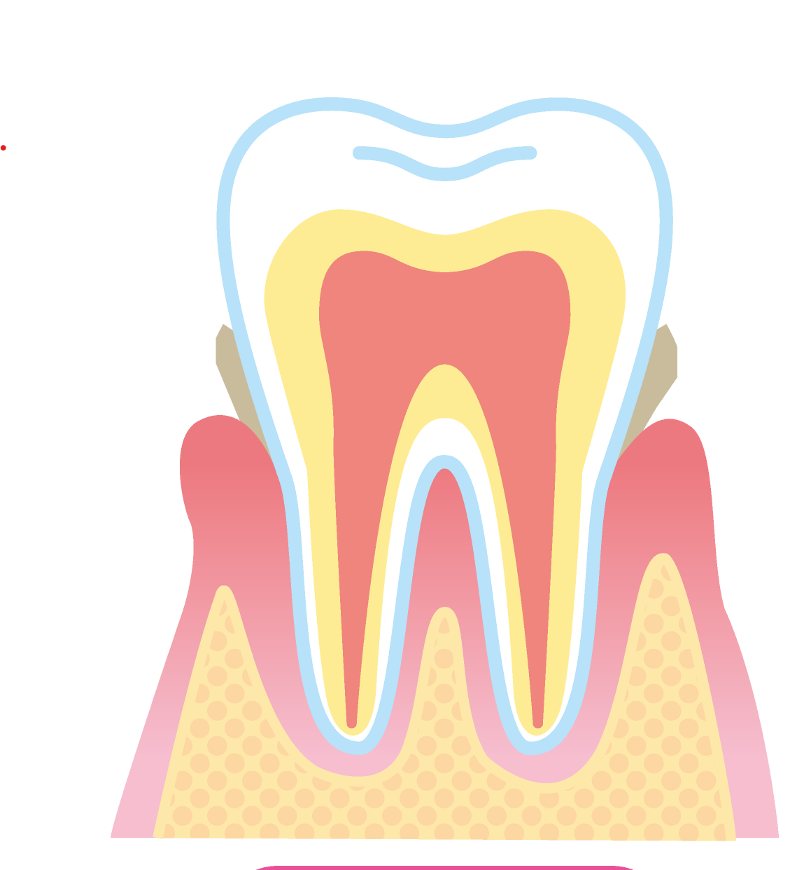 腫れた歯茎ののイラスト
